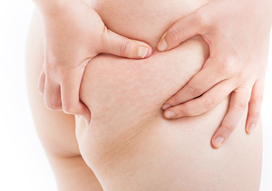 腰痛・膝痛・足のだるさ...身体の不調はおしりのむくみから！？