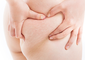 痩せていても、若くても起こりうる肉割れ。効率的にケアする方法とは？